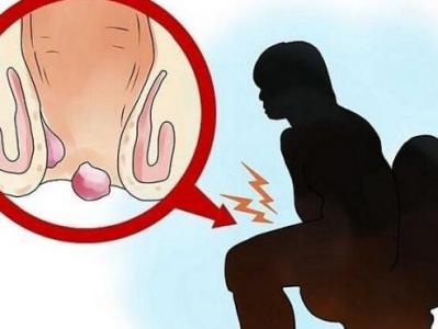 女性痔疮初期症状 痔疮的早期症状 了解痔疮的病因和种类
