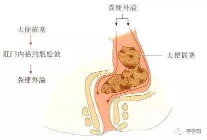 小腹隐痛肛门坠胀 小腹隐痛肛门坠胀 肛门内隐痛是怎么回事？