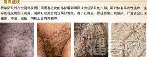 治疗阴虱方法有哪些 治疗阴虱 哪些方法能治疗阴虱