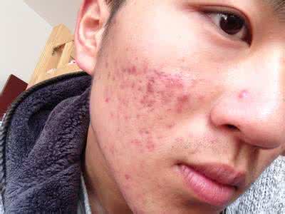 治疗痘印最好的办法 有什么办法去除痘印 去除痘印有什么好办法