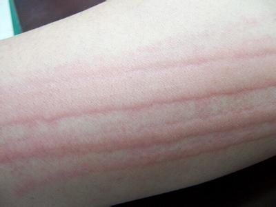 症状性皮肤划痕症 皮肤划痕症的原因 皮肤划痕症的症状与治疗