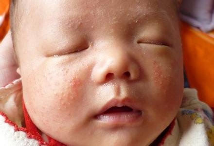 皮炎湿疹是什么症状 皮炎湿疹是什么 患者的食疗有哪些