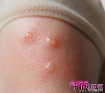 孕妇湿疹一般多久能好 孕妇湿疹是怎么引起的