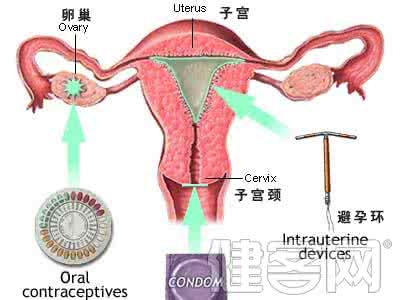 炎症性因素分析 避孕不当炎症感染 月经过多六大妇科因素