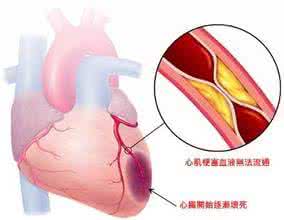 心梗征兆 黄安突发心梗 这些征兆需警惕