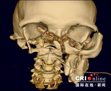 人造骨骼 人造骨骼 什么是＂人造骨＂