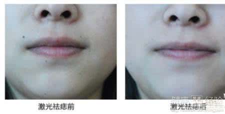 点痣后多久可以吃酱油 点痣后可以吃龙虾吗？