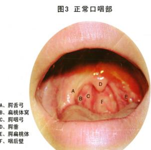 慢性咽炎如何根治 如何预防慢性咽炎 牢记5点咽炎去无踪