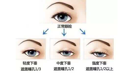 上睑下垂鉴别诊断 上睑下垂诊断标准 上睑下垂应该怎么样来诊断？