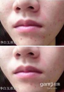 鼻子发红毛孔粗大 鼻子两侧发红毛孔粗大 鼻子毛孔粗大发红怎么办