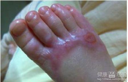 烫伤疤痕怎么治疗 怎么烫伤治烫伤？