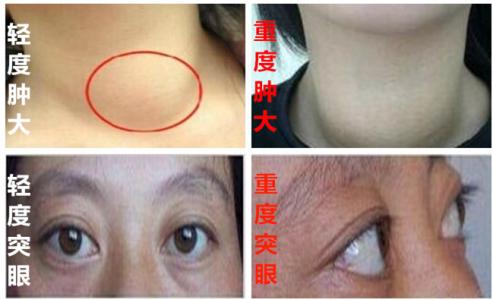 女性甲减最明显的症状 女性甲减最明显的症状 女性性病有哪些明显症状