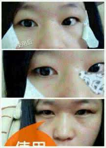 有了黑眼圈该怎么办 黑眼圈水肿脸上油多该怎么办