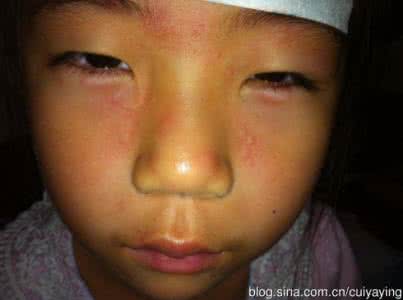 柴胡加龙骨牡蛎汤医案 河北田大哲医生医案:柴胡加龙骨牡蛎汤治疗荨麻疹