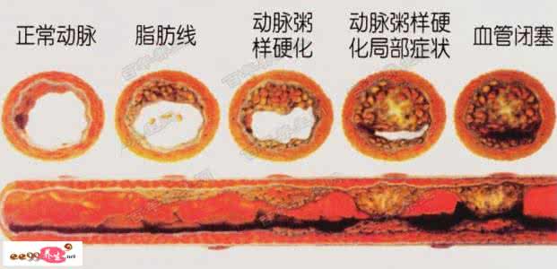 动脉硬化的症状有哪些 动脉硬化的症状 动脉硬化有哪些表现