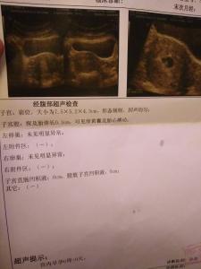 先兆流产流出血块 孕囊旁有血块怎么办?有可能是先兆流产