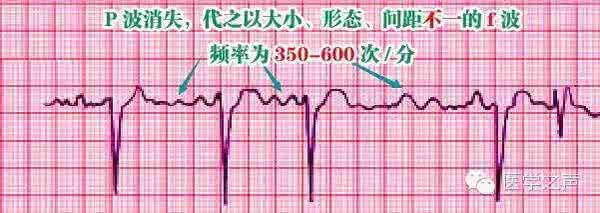 不知道还有什么理由 这样教你看心电图，还有什么理由不会呢？年轻医生围过来……