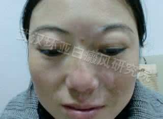 前列腺炎的发病因素 白癜风遗传吗 白癜风的发病因素