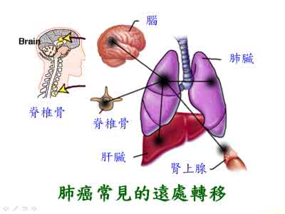 肺癌手术后转移到肝脏 肺癌手术后转移到肝脏 肺癌转移肝脏 不同类型治疗肺癌的方法