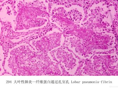 大叶性肺炎治疗方案 大叶性肺炎如何治疗 应怎样预防成人大叶性肺炎