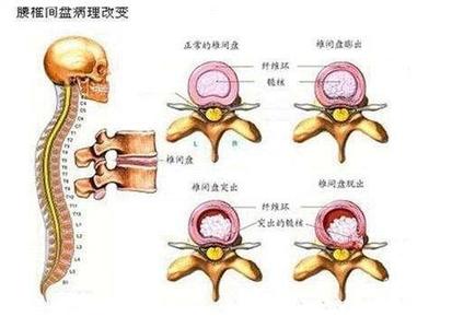 腰间盘突出小方子 治疗腰间盘突出小方子，七天见效