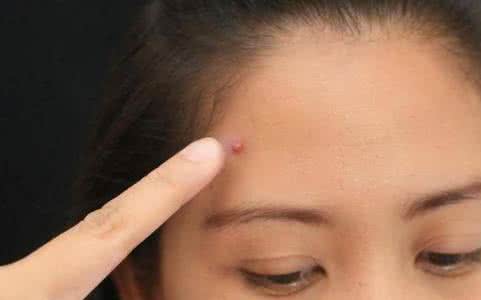 男生去痘印的最快方法 痘男痘女们都过来看看