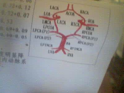 脑动脉硬化 每月不到50元，6个月中度脑动脉硬化喝好了！
