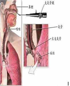 支气管镜检查 支气管镜检查 支气管镜出血怎么办？