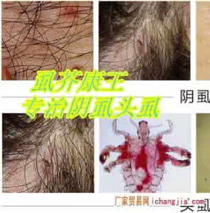 阴虱多长时间能治好 阴虱多长时间能治好 白癜风治疗多长时间能好？