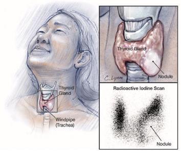 甲状腺多发性结节 甲状腺多发性结节危害 多发性甲状腺瘤严重吗？危害有大多呢？