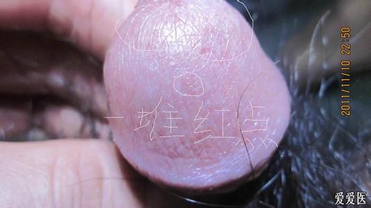 高血压有哪些常见症状 性病有哪些常见症状 什么是性病？性病的症状有哪些
