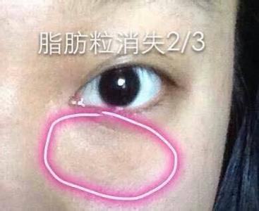 眼袋脂肪粒怎么消除 怎么消除脂肪粒