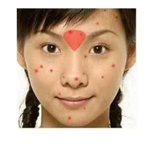 脸上长痘痘是怎么回事 长痘痘后千万不可以做的事