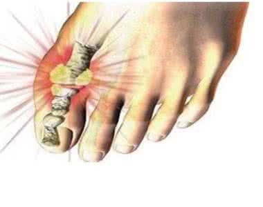 膝关节痛风怎么治疗 假性痛风怎么治疗 膝关节痛风?也可能只是“假性痛风”!