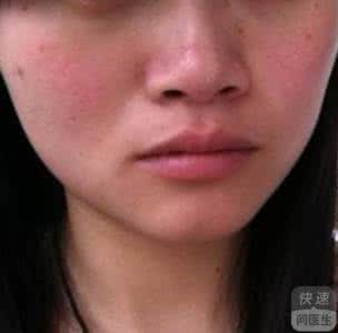 面部皮肤过敏的症状 面部皮肤过敏的症状 面部过敏的症状