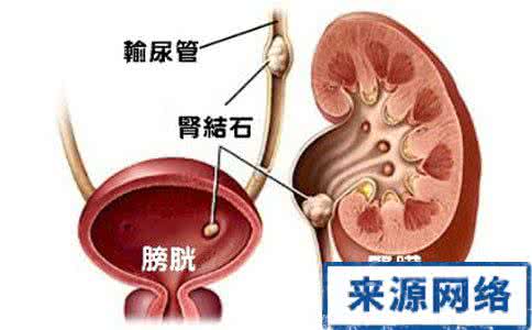 金刚菩提基础知识普及 肾结石的基础知识普及