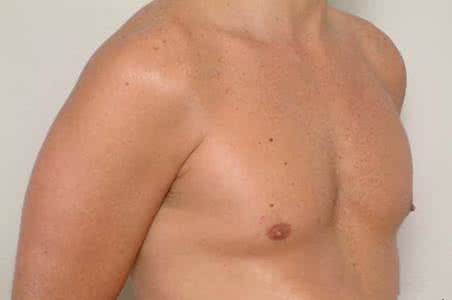 男孩乳腺发育症 男孩乳腺发育症 男孩乳腺发育如何进行治疗