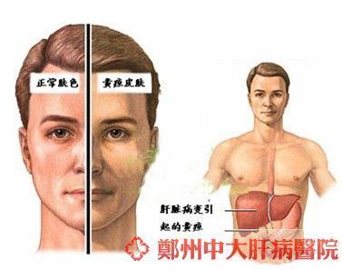 肝炎的早期症状表现 肝炎的早期症状表现 肝炎的表现 肝炎的早期症状有哪些