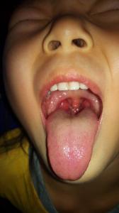 国医大师经方验案精选 经方败案群201500604 小儿扁桃体疾病专题系列(共6场)刘卫红脉象