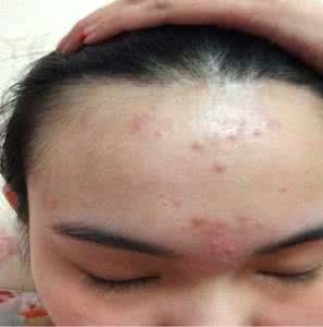 毛囊炎是否传染 毛囊炎传染吗 正确认识毛囊炎是否传染