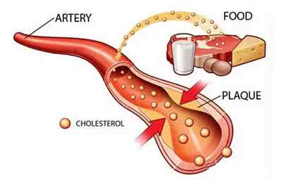 心血管疾病高危人群 心血管疾病 胆固醇 别让高胆固醇“堵”了血管