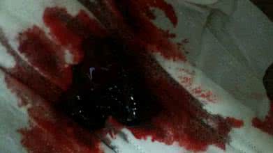 月经好多血块怎么回事 月经有黑色血块 月经有黑色血块怎么回事