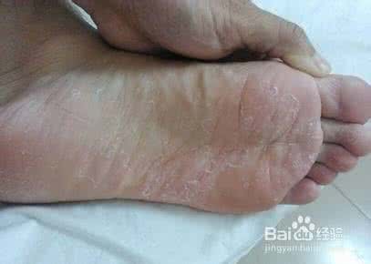 脚底脱皮怎么治疗 脚底脱皮是怎么回事