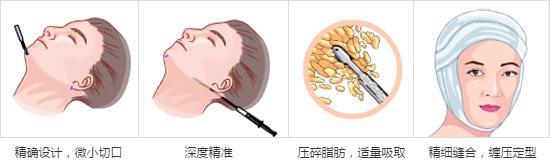 影响因素 面部吸脂价格影响因素 影响腹部吸脂价格的因素