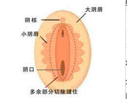 小阴唇肥大手术多少钱 小阴唇肥大手术多少钱 什么情况下可以实施小阴唇肥大手术