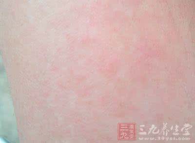 汗斑外用什么 发现汗斑，试试外用小验方