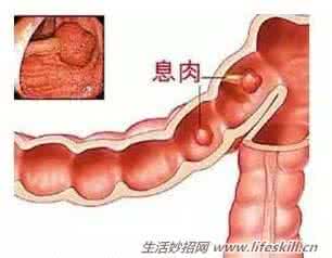 内痔疮的最佳治疗方法 痔疮治疗方法 试试中医治痔疮的妙招