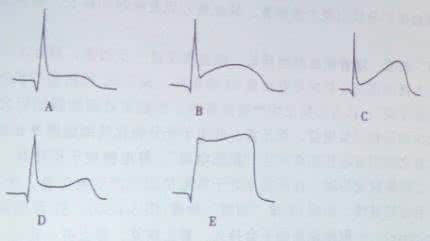 急性冠脉综合征心电图 急性冠脉综合征的心电图识别与诊断