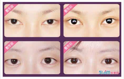 埋线双眼皮术后护理 埋线双眼皮术后护理 双眼皮术后的自我护理