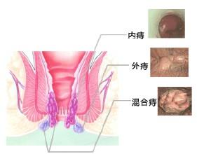 小儿痔疮症状图片 小儿痔疮怎么办